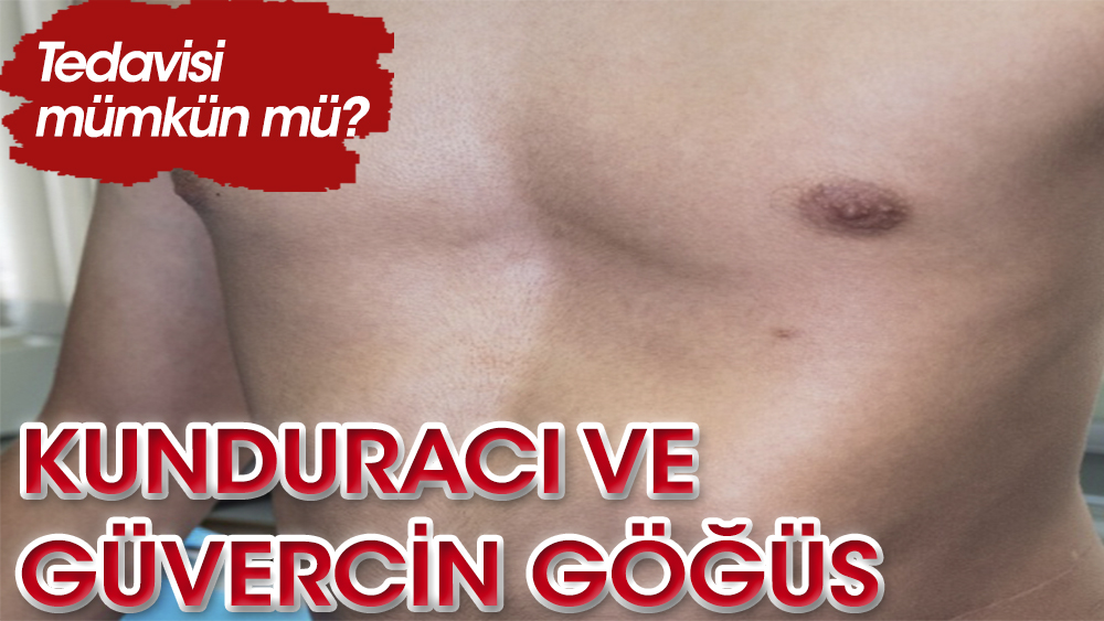 Kundurac Ve G Vercin G S Nedir Tedavisi M Mk N M