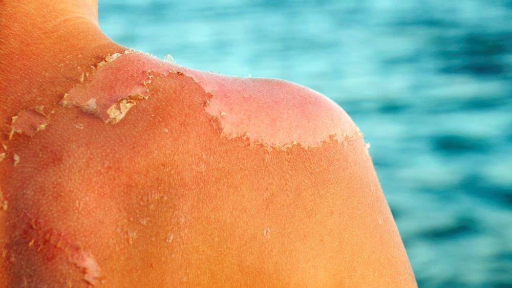 Güneşte yanan deri neden soyulur? Hücreler kendi yaşamına son verir ve vücuttan ayrılır 10