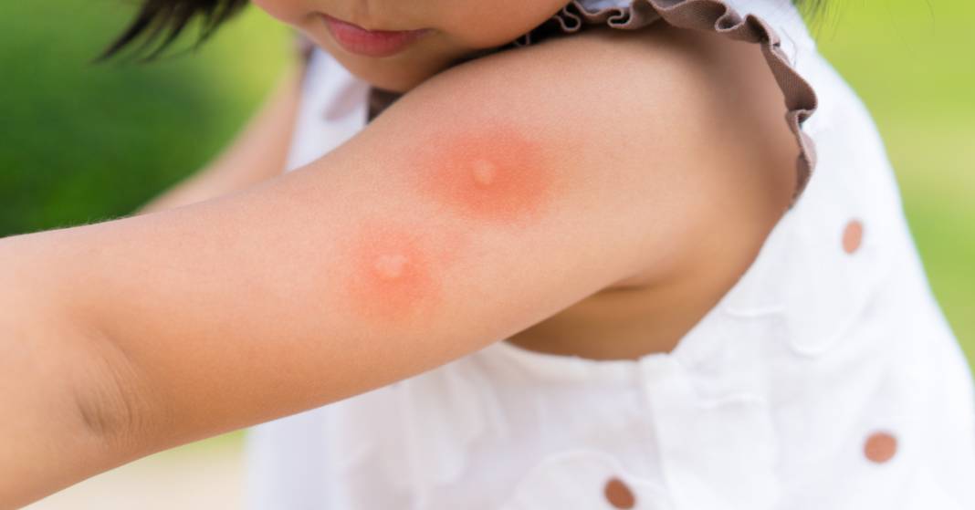 Sivrisineklerin en çok ısırdığı kan grubu belli oldu. Herkes ısırılma riskini öğrensin 1
