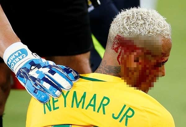 Neymar maçta kanlar içinde kaldı 1