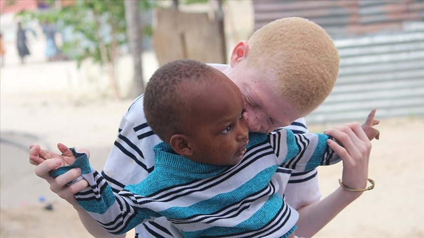 Afrikalı albinolar 'beyaz' bir gelecek ümidiyle yaşıyor 1