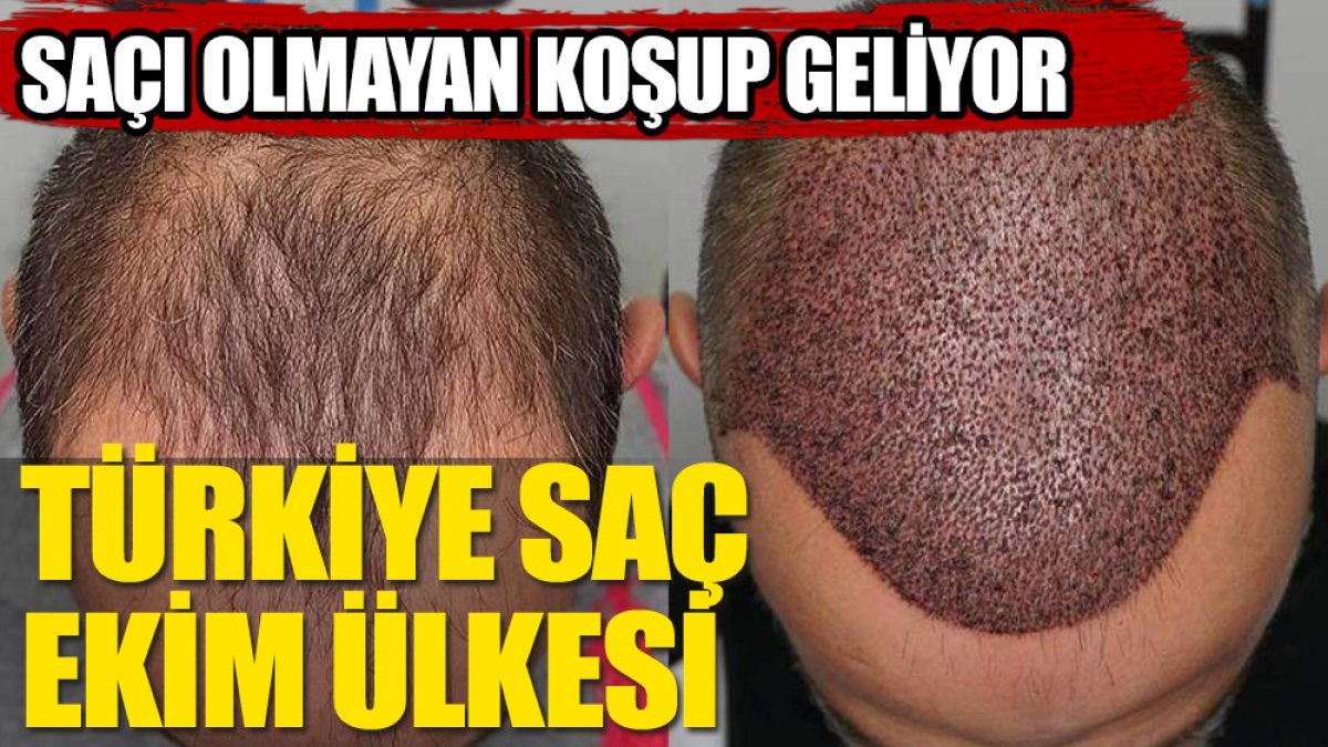 Küresel saç ekiminin adresi Türkiye
