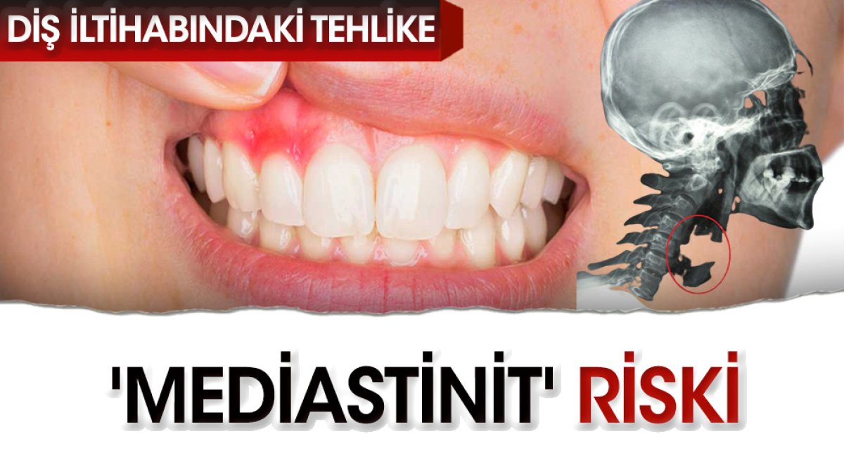 Diş iltihabında mediastinit riski