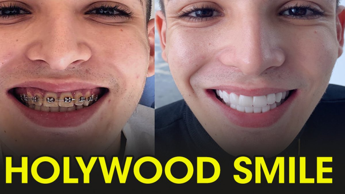 ‘Hollywood Smile' e ilgi artıyor