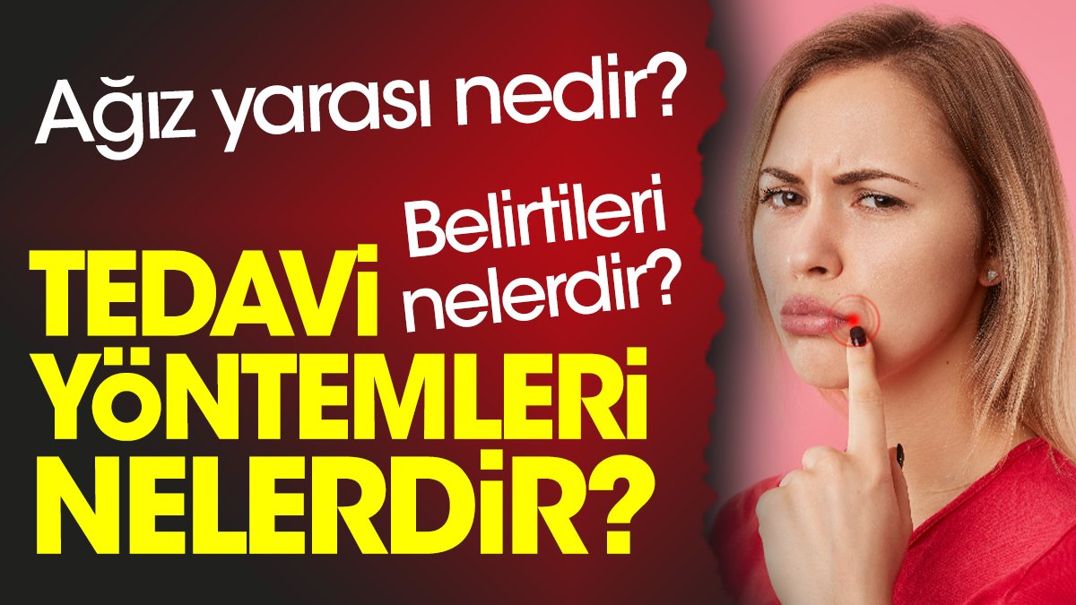 Ağız yarası nedir? Ağız yarası belirtileri nelerdir? Ağız yarası tedavi ...