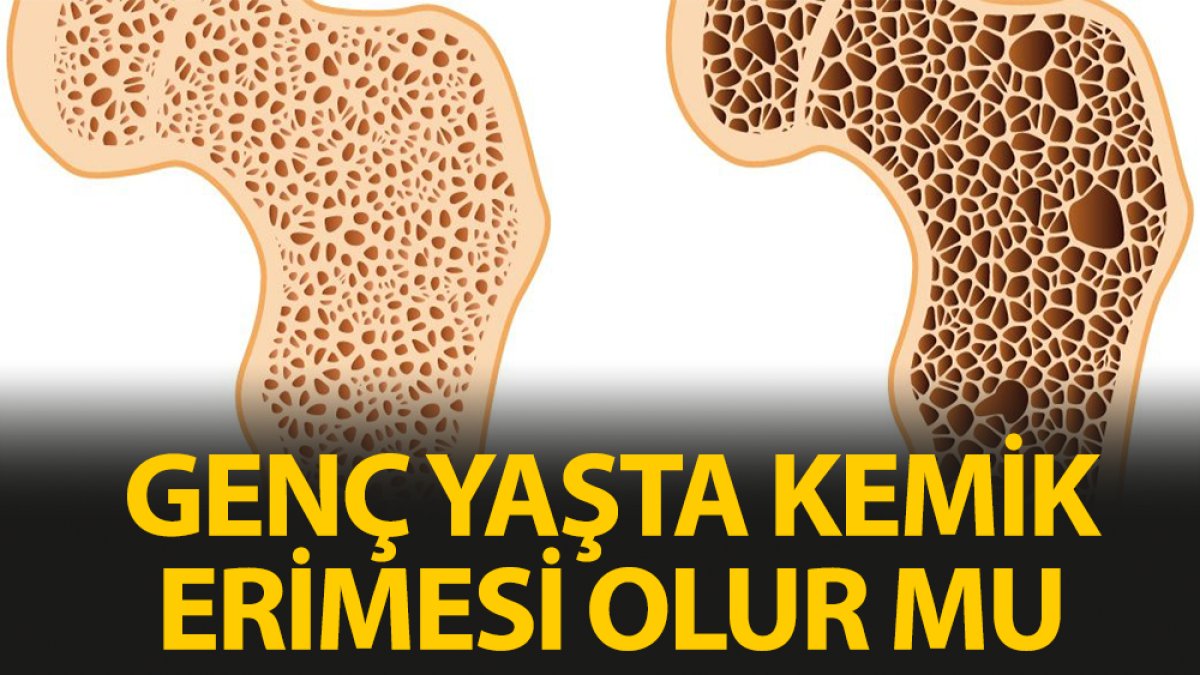 Genç yaşta kemik erimesi olursa neler yapılmalı