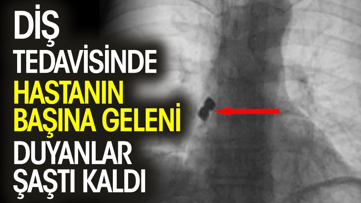 Diş tedavisinde hastanın başına geleni duyanlar şaştı kaldı