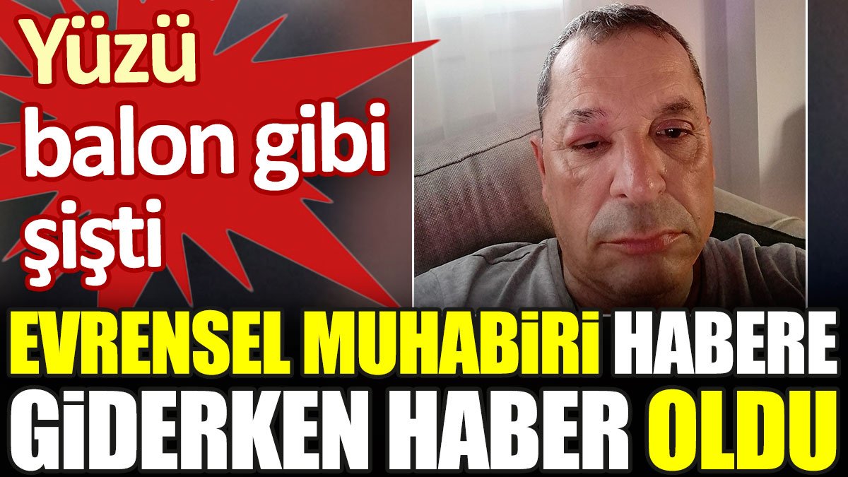 Evrensel muhabiri habere giderken haber oldu. Yüzü balon gibi şişti