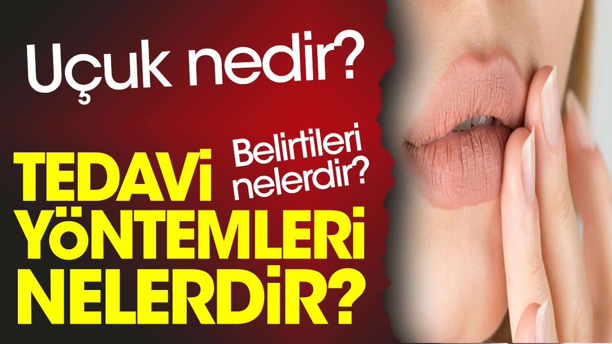 Uçuk nedir? Uçuk belirtileri nelerdir? Uçuk tedavi yöntemleri nelerdir?