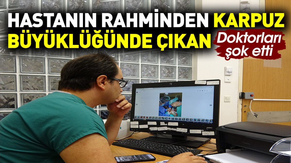 Hastanın rahminden karpuz büyüklüğünde çıkan doktorları şok etti