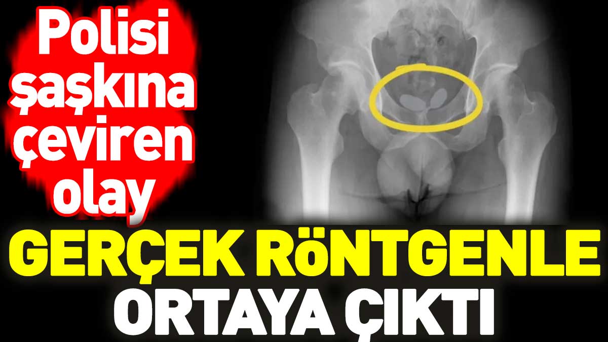 Polisi şaşkına çeviren olay. Gerçek röntgenle ortaya çıktı