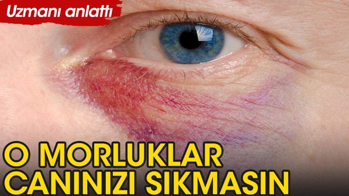 Uzmanı açıkladı: Gözaltı morluklarına veda edin