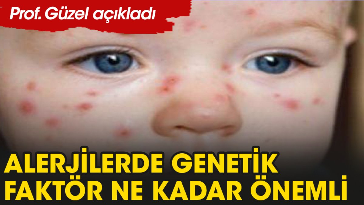Çocuk alerjileri genetik midir