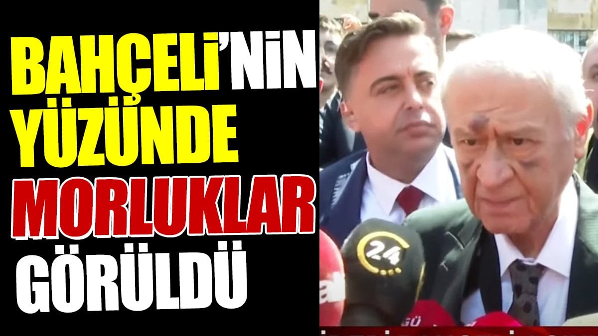 Son dakika.. Bahçeli'nin yüzünde morluklar görüldü