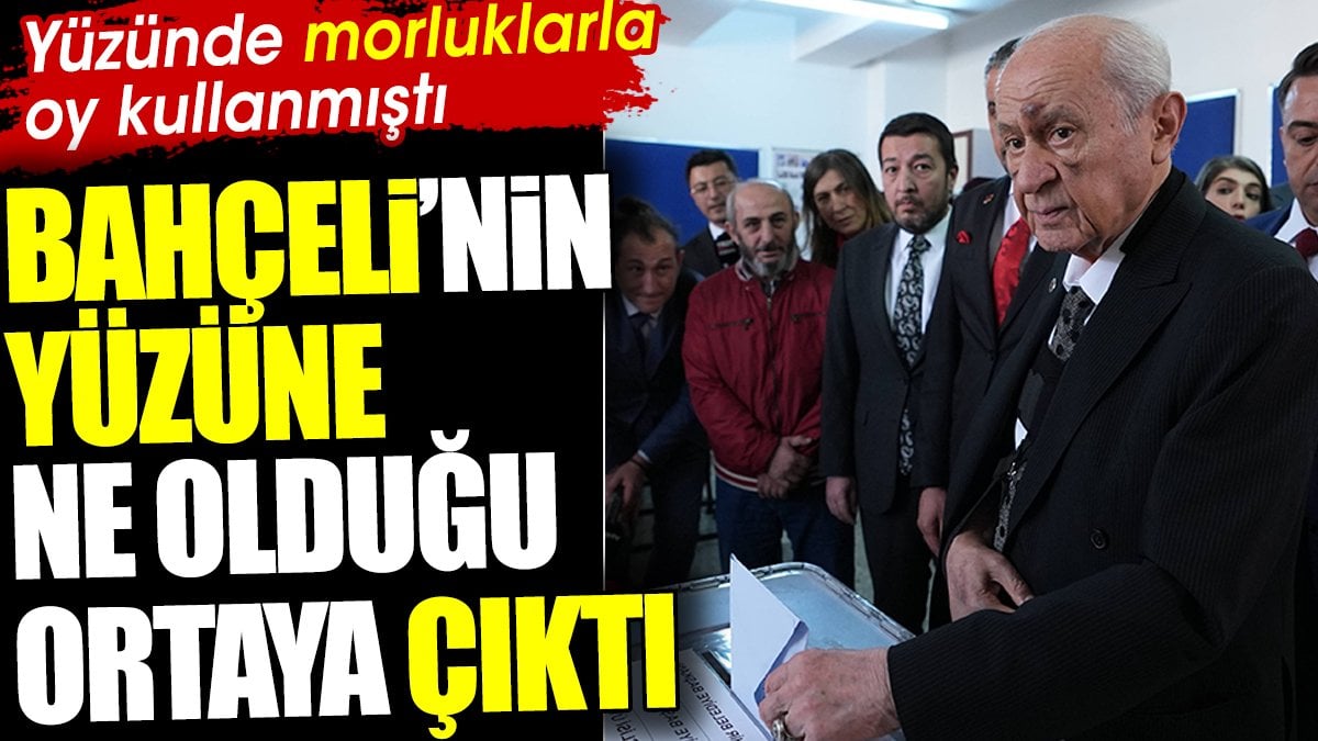 Bahçeli'nin yüzüne ne olduğu ortaya çıktı. Yüzünde morluklarla oy kullanmıştı