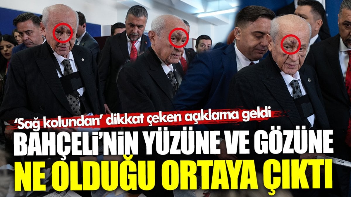 Devlet Bahçeli’nin yüzü ve gözü neden morardı? En yakınındaki isimden dikkat çeken açıklama