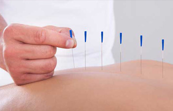 Tüp bebek tedavisinde akupunktur yöntemi