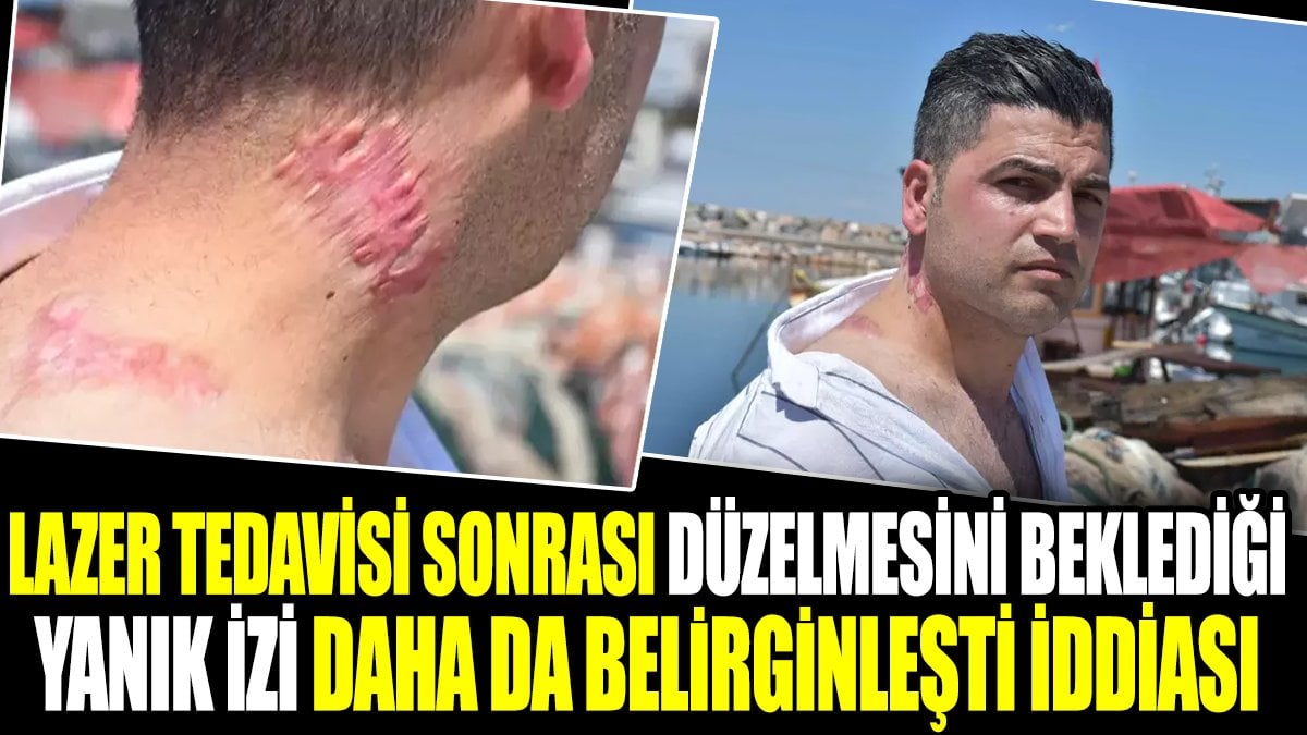 Lazer tedavisi sonrası düzelmesini beklediği yanık izi daha da belirginleşti iddiası