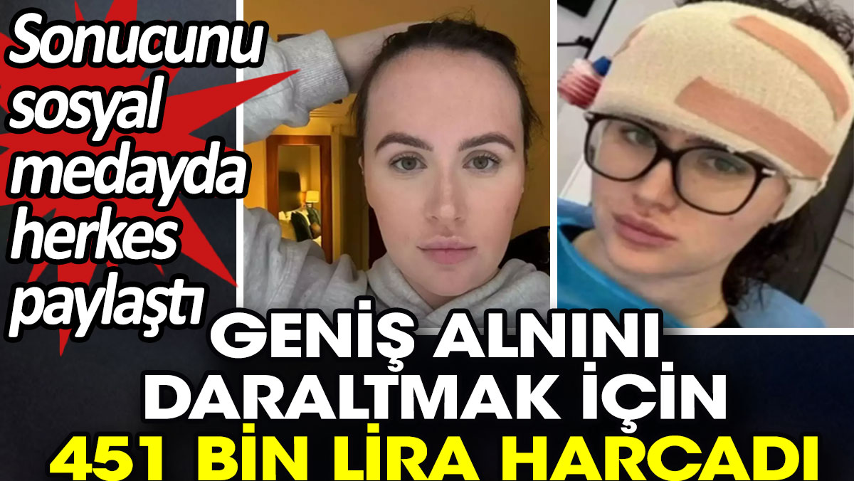 Geniş alnını daraltmak için 451 bin lira harcadı. Sonucunu sosyal medyada herkes paylaştı