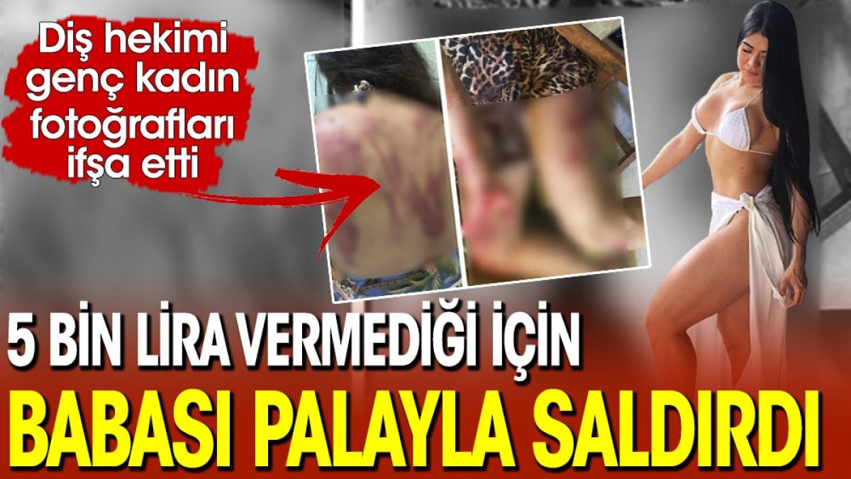 Diş hekimi genç kadın ifşa etti! 5 bin lira vermediği için babası palayla saldırdı