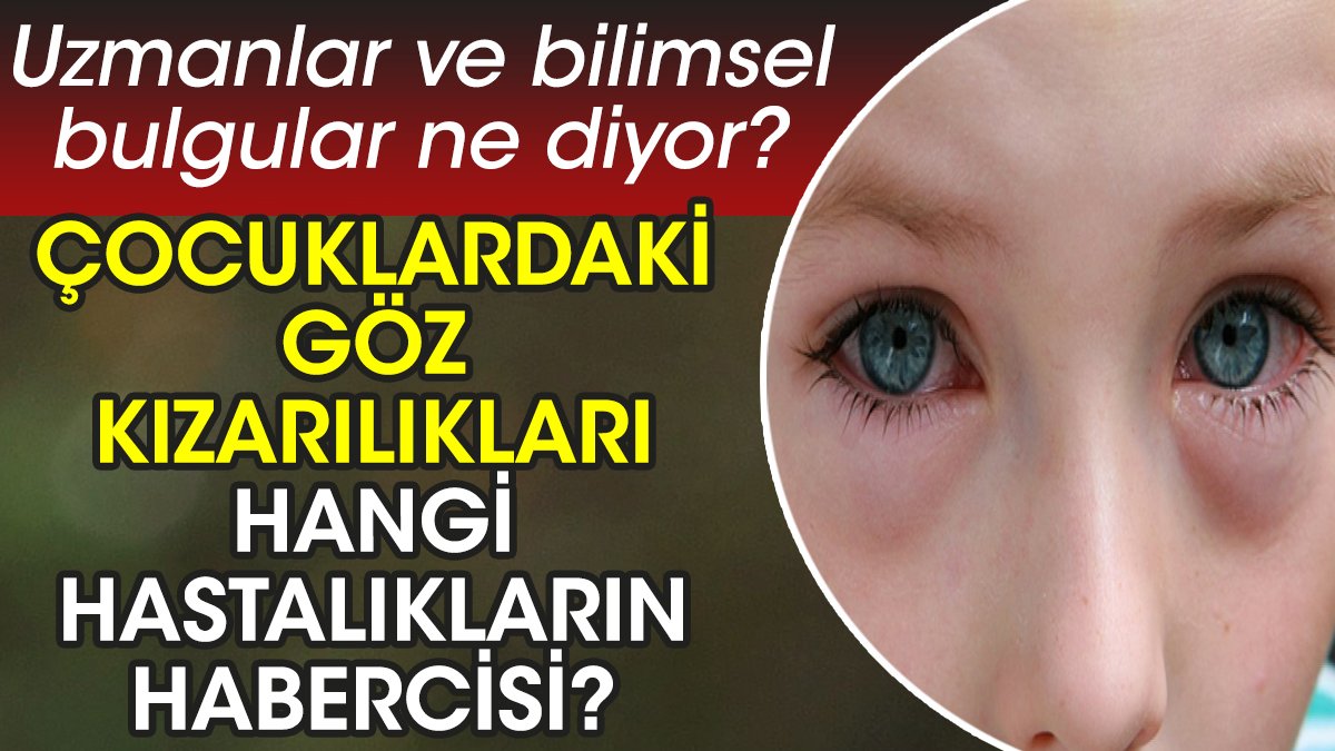 Çocuklardaki göz kızarılıkları hangi hastalıkların habercisi? Uzmanlar ve bilimsel bulgular ne diyor?