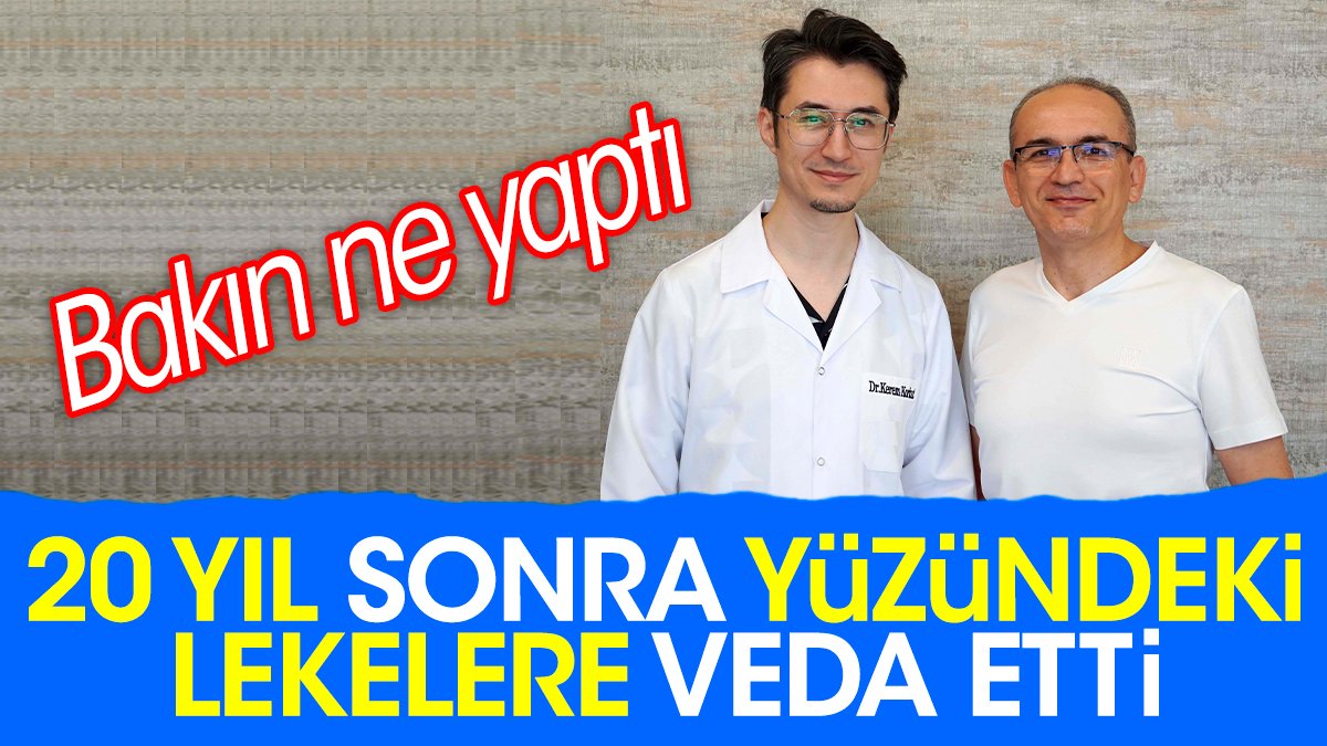 20 yıl sonra yüzündeki lekelere veda etti. Bakın ne yaptı