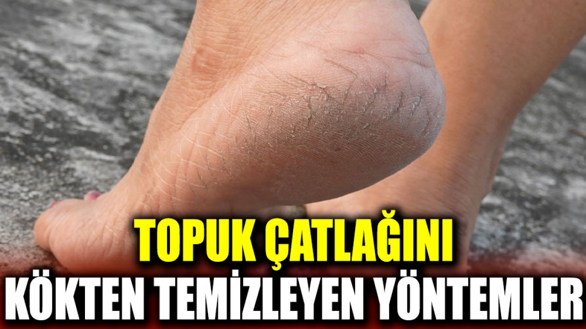 Topuk çatlağını kökten temizleyen yöntemler