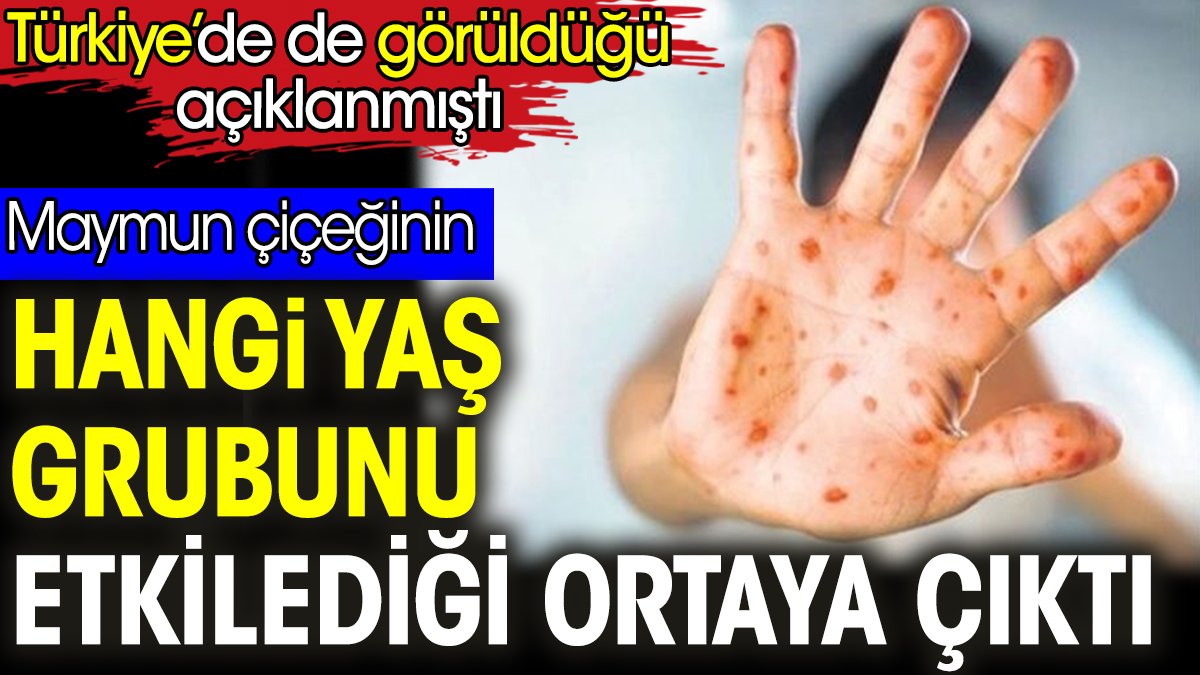 Maymun çiçeğinin hangi yaş grubunu etkilediği ortaya çıktı. Türkiye’de de görüldüğü açıklanmıştı