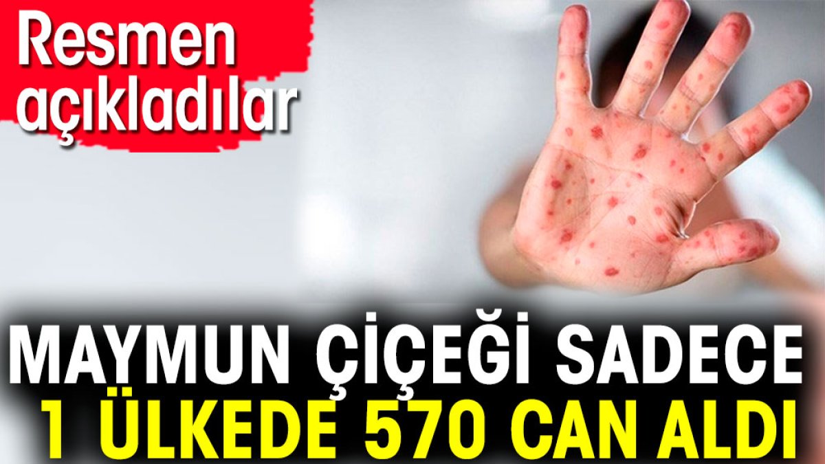 Maymun çiçeği sadece 1 ülkede 570 can aldı. Resmen açıkladılar