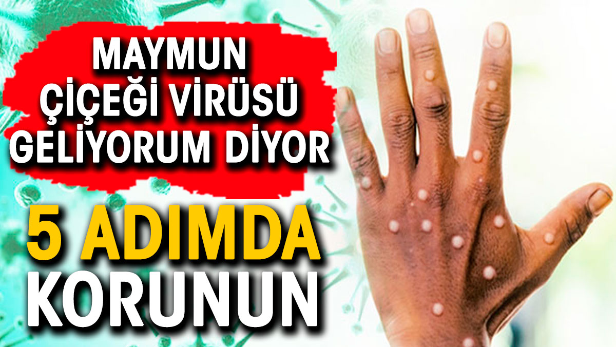 Maymun çiçeği virüsü geliyorum diyor. 5 adımda korunun