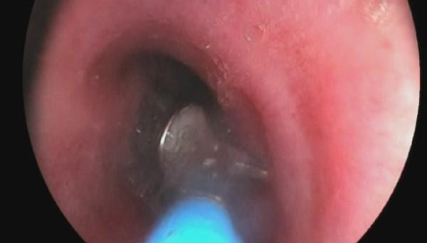 Endoskopi yapan doktor akciğerin içinde gördü gözlerine inanamadı - Resim : 5