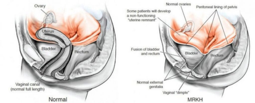 Cinsel organı ve rahmi olmadan doğdu - Resim : 3