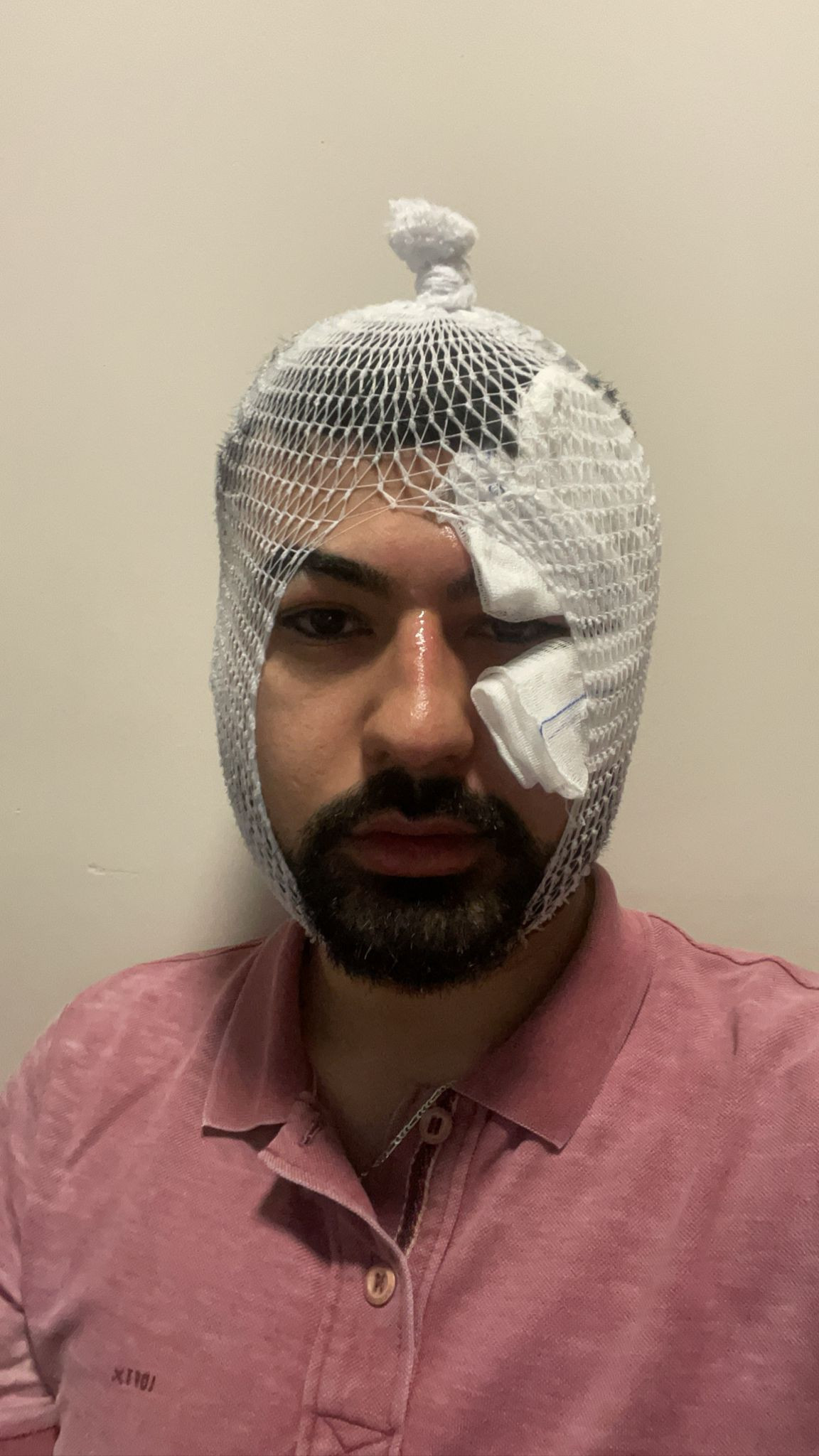 Fildişi macunu deneyi yaparken yüzünü yaktı - Resim : 4