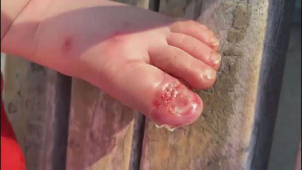 Suriyeli babadan 2 yaşındaki çocuğuna sigaralı işkenceye şoke eden savunma - Resim : 1