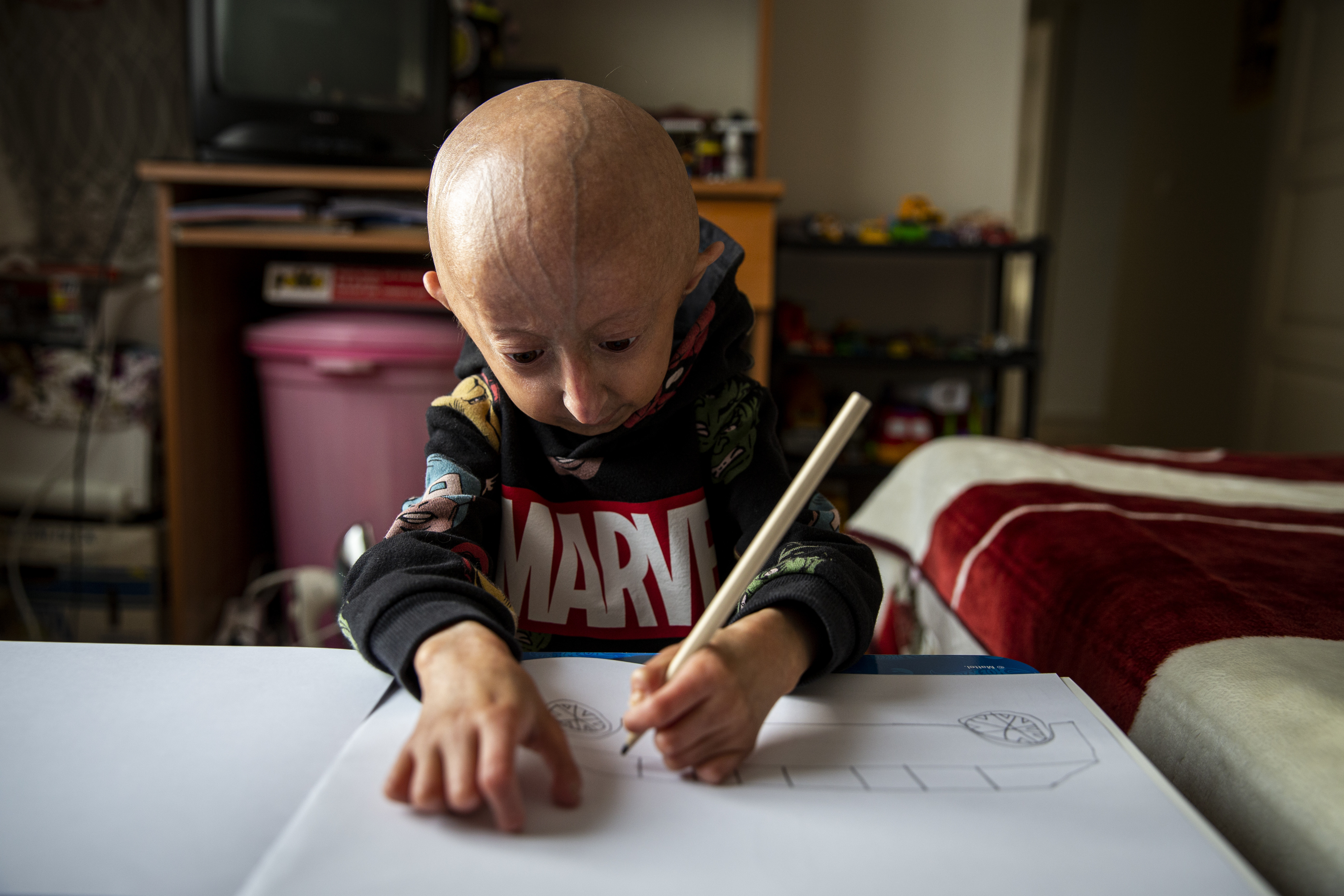 8 milyonda 1 görülüyor | 9 yaşındaki Veysel’in “Benjamin Button” hastalığıyla mücadelesi! - Resim : 4