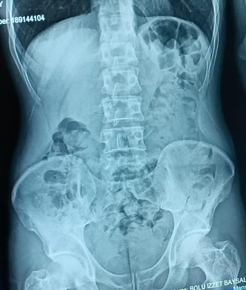 Röntgen filmine bakan doktorların ağzı açık kaldı - Resim : 2