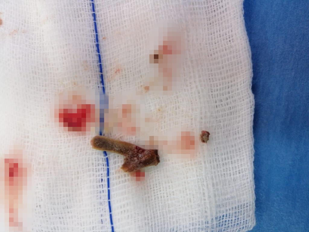 Öksürük şikayetiyle hastaneye gitti, 5 yıldır akciğerinde lades kemiğiyle yaşadığını öğrendi - Resim : 2