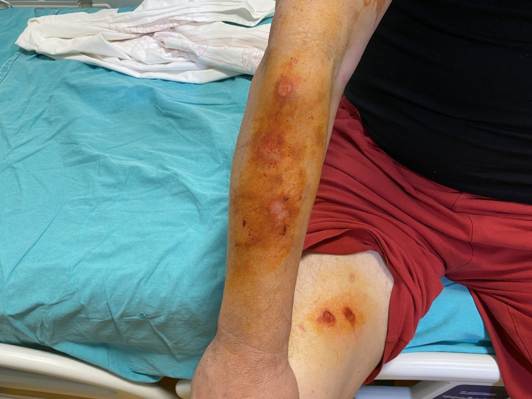 Lavabo açıcı bomba gibi patladı, soluğu hastanede aldı - Resim : 2