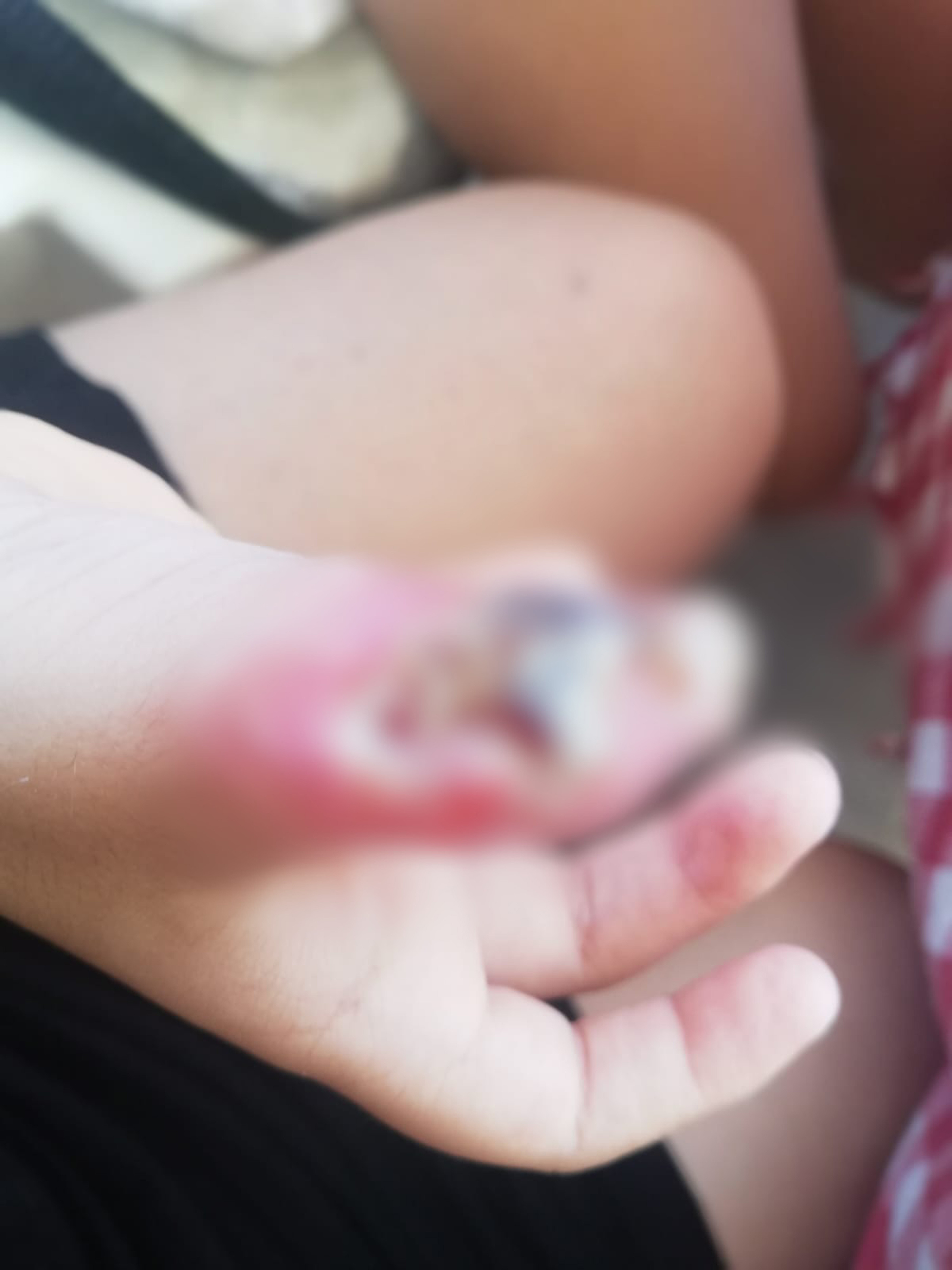 6 yaşındaki çocuğu MR'da yaktılar - Resim : 2