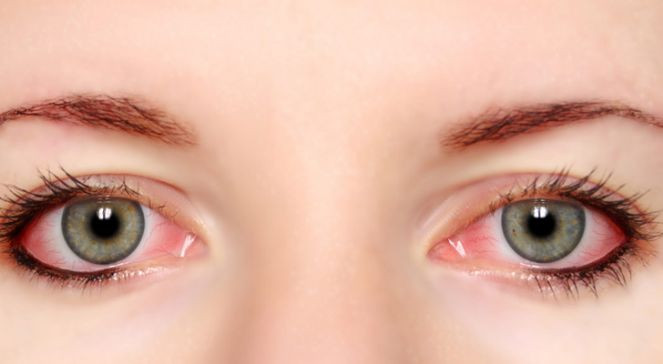 Göz kızarıklığı ihmale gelmez doktora gitmeli - Resim : 2