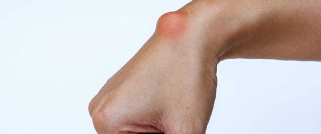 ''Ganglion kisti''hangi mesleklerde görülüyor - Resim : 2