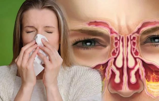 nasal-congestion-is-a-sign-of-another-disease-archynewsy