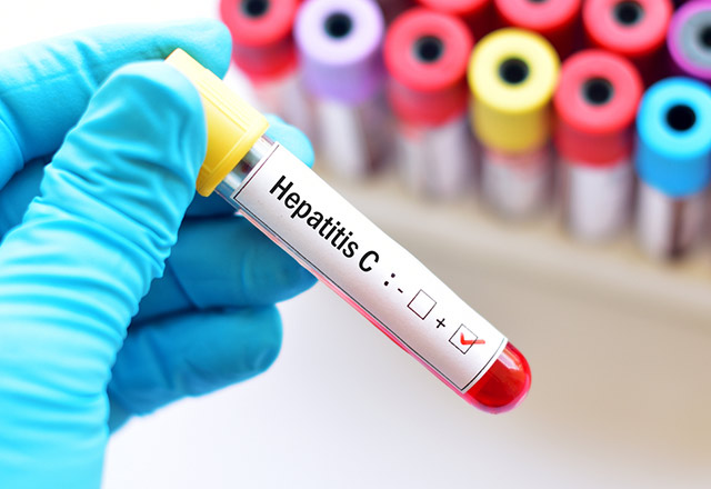 Türkiye’de her 100 kişiden 1’i Hepatit C hastası
