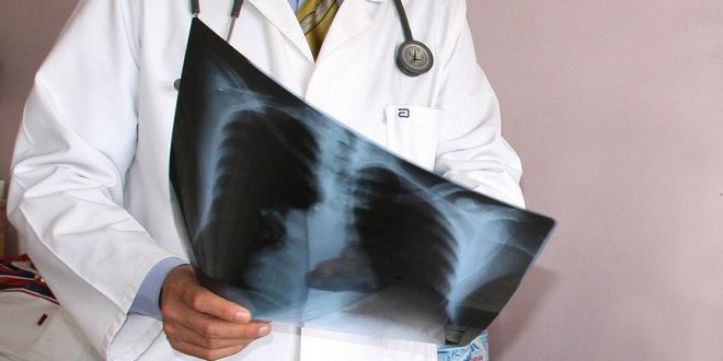 Kadınlarda akciğer kanserinden ölümlerde artış görülebilir