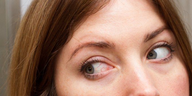 Gözlerdeki kanlanma göz tümörünün belirtisi olabilir!