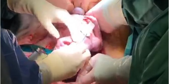 Bebek göbek kordonu kesilmeden ameliyat edil