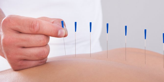 Akupunktur açlık duygusunu düzenliyor! Akupunkturun faydaları nelerdir?