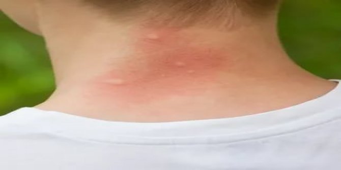 Sivrisinek ısırdığında vücudunuza ne olur?