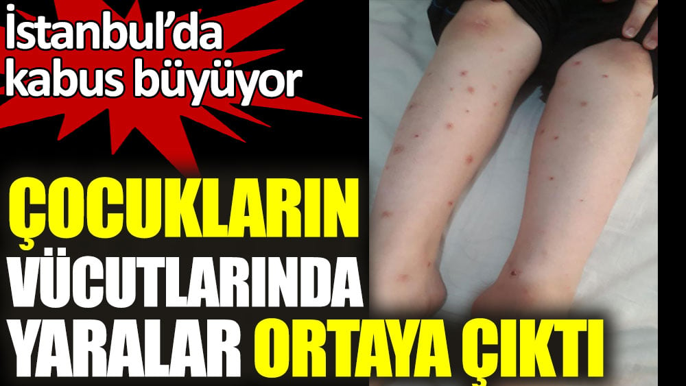 İstanbul’da kabus büyüyor. Çocukların vücutlarında yaralar ortaya çıktı