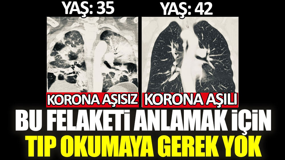 Aşı olanlarda korona virüs akciğere zarar vermiyor! İşte 2 kişiye ait tomografi sonuçları